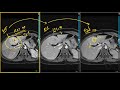 Focal Nodular Hyperplasia, Typical Appearance on Liver MRI