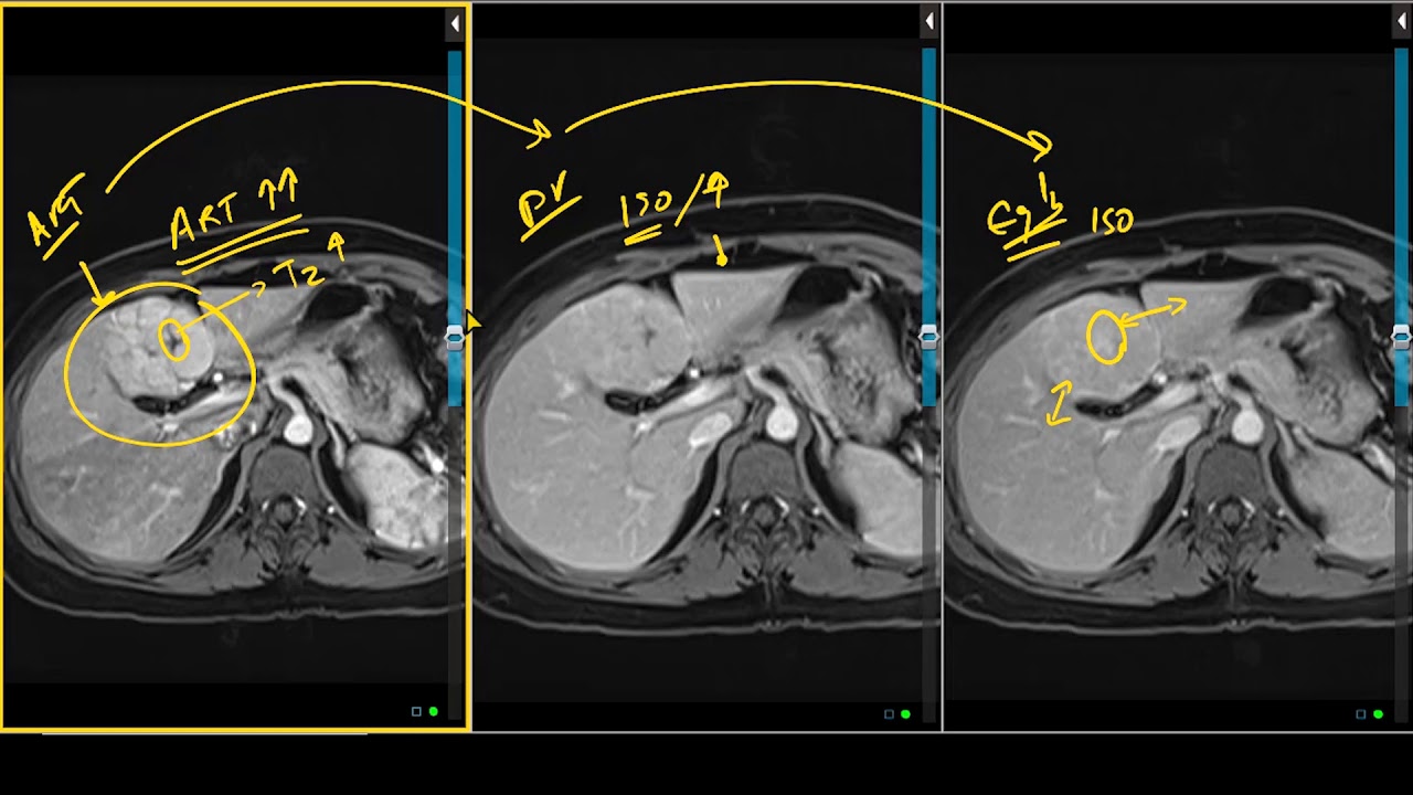 Focal Nodular Hyperplasia Typical Appearance On Liver Mri Youtube