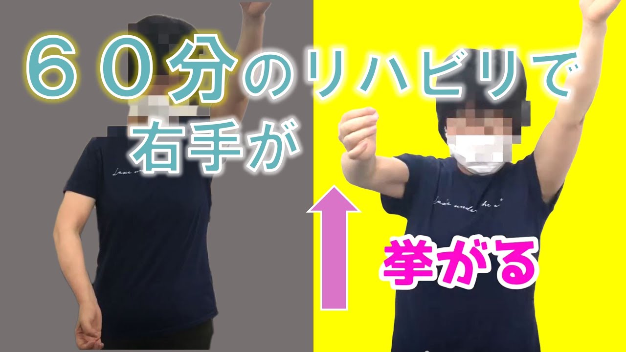 【片麻痺の亜脱臼】って1回60分のリハビリで良くなるの？脳卒中 東京/保険外リハビリ upper-limb Exercises for stroke patients