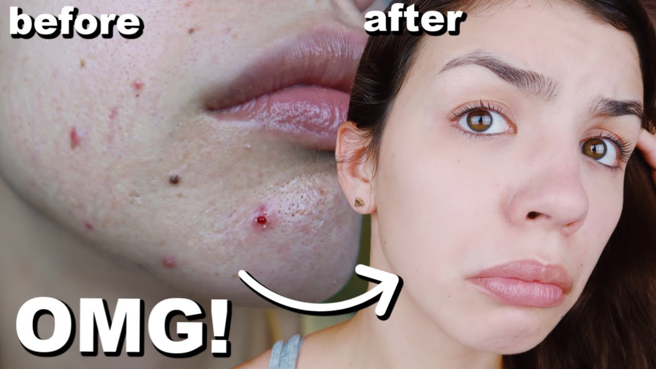 I Didn T Wash My Face For One Week And This Is What Happened Youtube