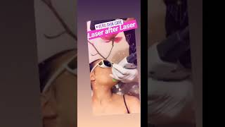 Chin Laser Hair removal @ Vero Skin Care - Yonkers, NY