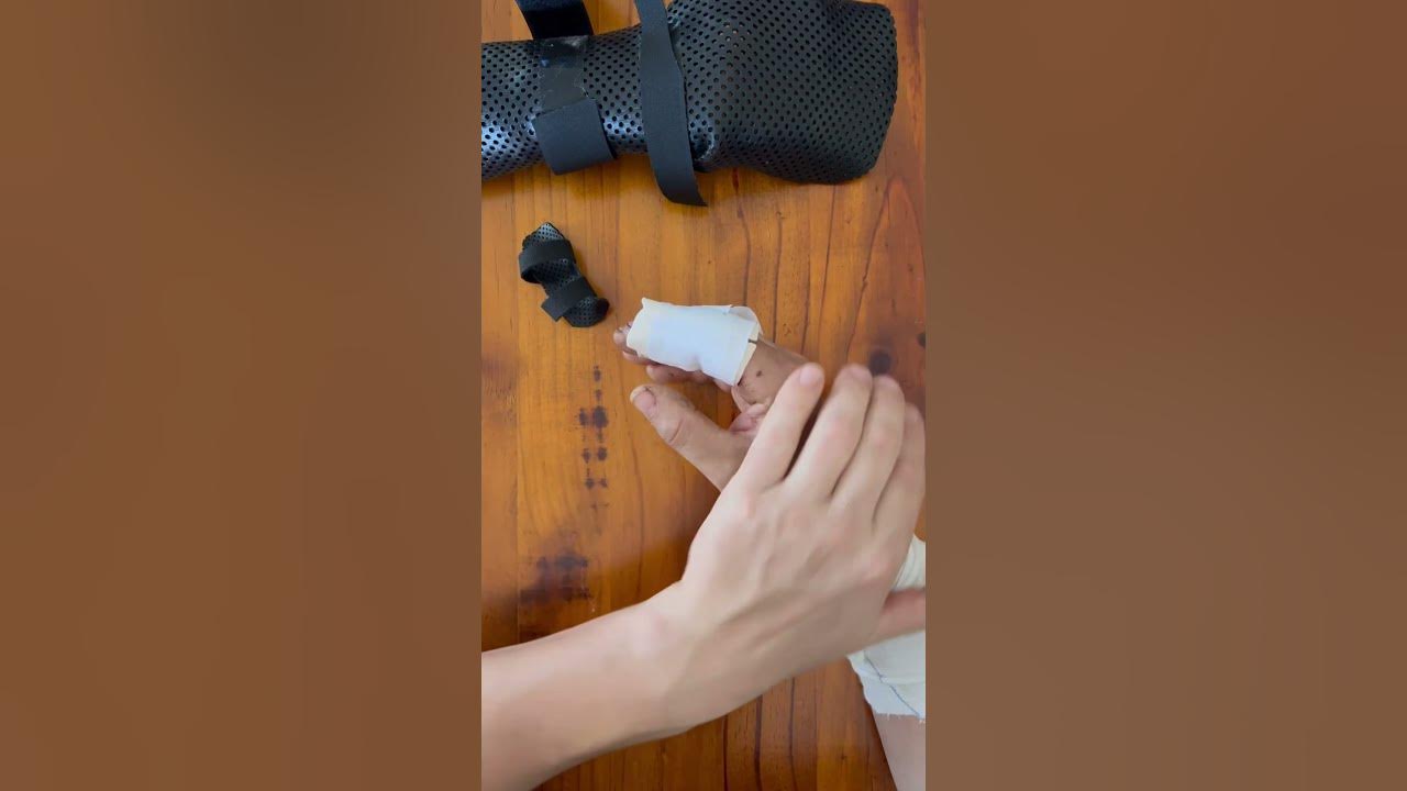Bandsaw amputation accident. Recovery. woodturning woodworking YouTube