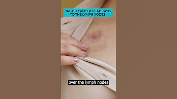 Spotting Symptoms Of Breast Cancer Metastasis To Lymph Nodes Cancer Metastasis Cancerawareness 
