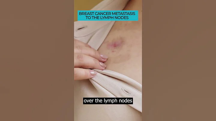 Spotting Symptoms of Breast Cancer Metastasis to Lymph Nodes 🎗️🔍#Cancer #Metastasis #cancerawareness - DayDayNews