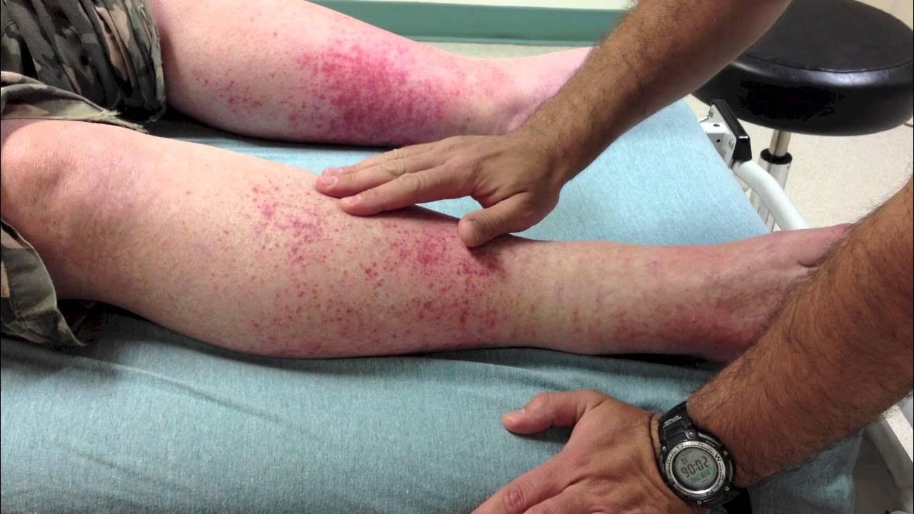 vasculitis YouTube