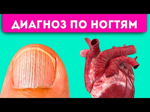 Маникюр Не Спасет! 8 Проблем С Ногтями, Которые Укажут На Сердце, Легкие, Желудок И Даже