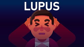 The Disease That Has A Thousand Symptoms | LUPUS Kia Hai? | UrduFreeAnimatedEducation