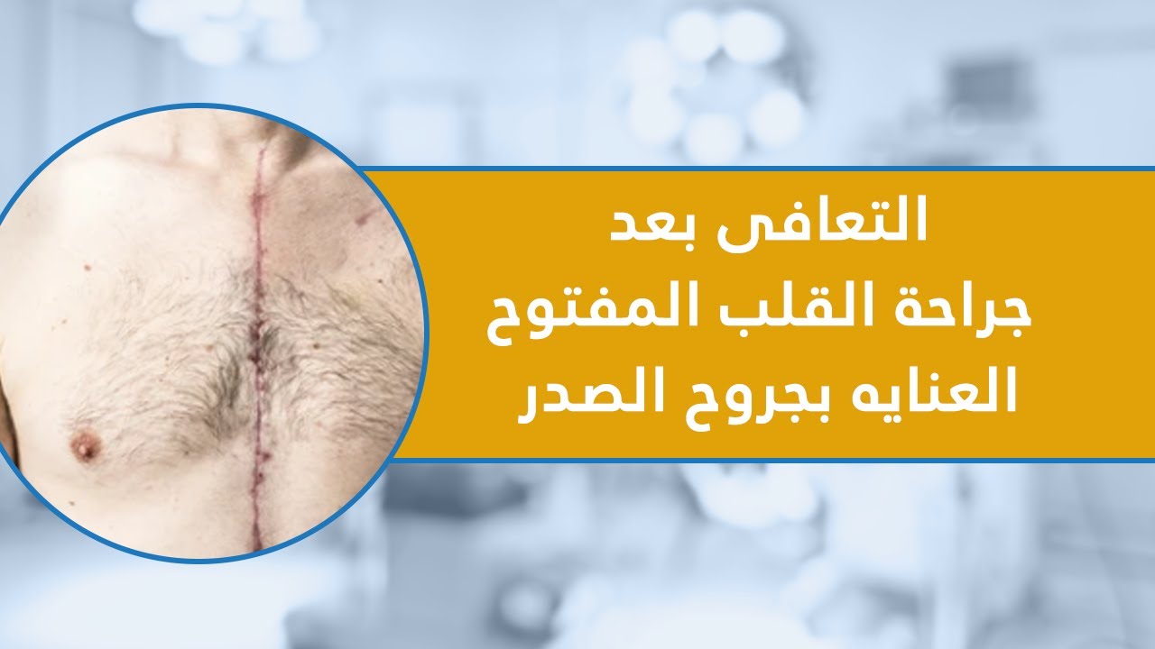 التعافي بعد جراحة القلب المفتوح - العناية بجروح الصدر