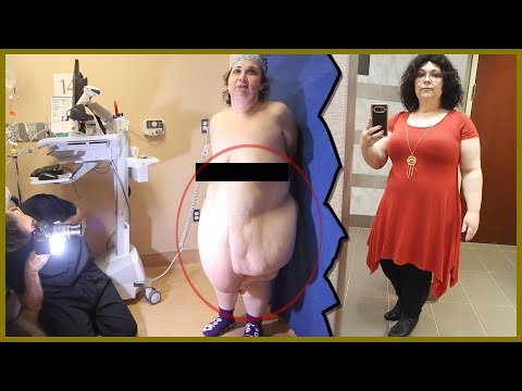 Panniculectomy After Massive Weight Loss - Transformation Tuesday with Dr. Katzen