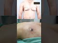 Gynecomastia Surgery