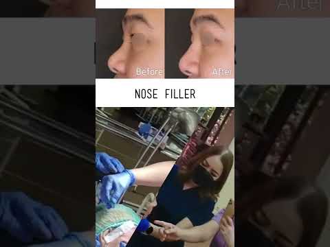 Nose Beautification With Filler