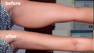 Remove dangling arms, get slim arm in 7 days really fast 100% working