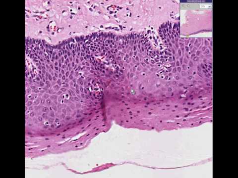 Histopathology Vulva--Severe dysplasia