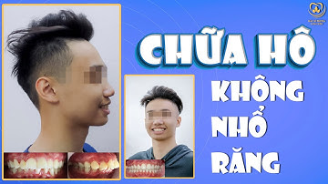 Chữa Hô Không Nhổ Răng | Các Case Lâm Sàng #9