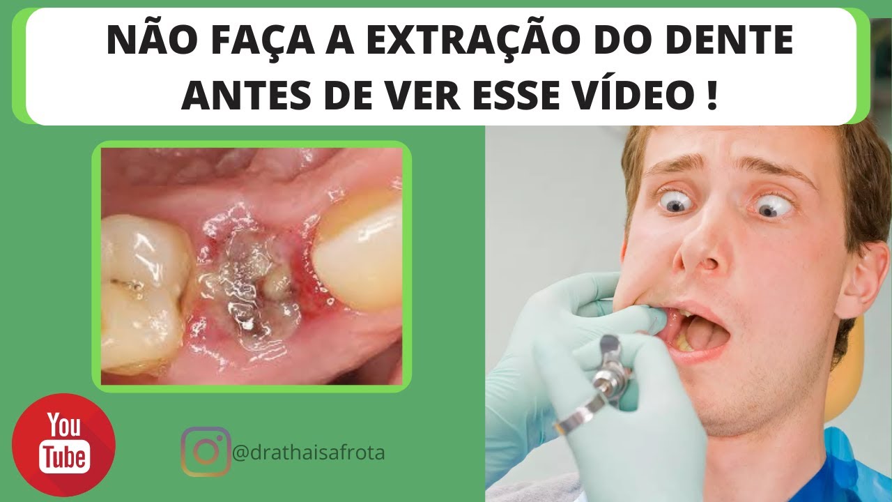 Infecção no dente após a extração, o que eu devo fazer ? - YouTube