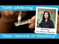 Do I need stain removal or bleaching to make my teeth whiter?