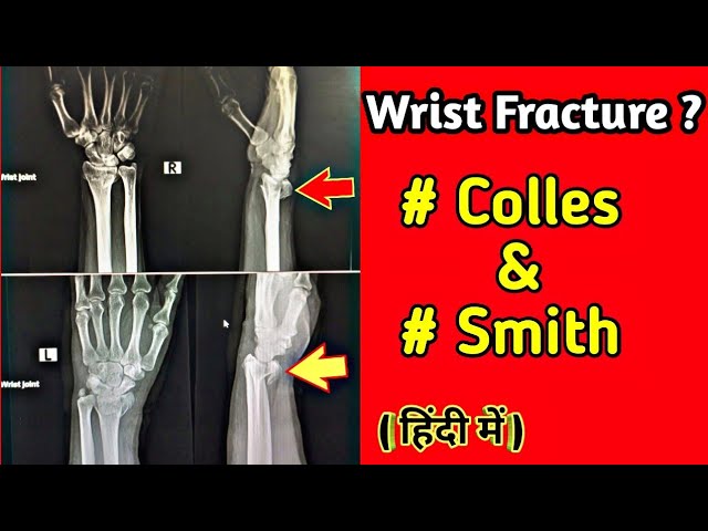Colles vs Smith Fracture X-ray Findings, Distal Radius Fracture, Xray  Wrist Fracture