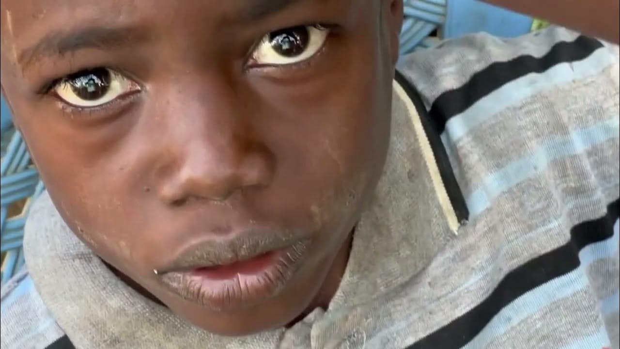 How to Remove Tunga AKA Jiggers, Medical Video YouTube