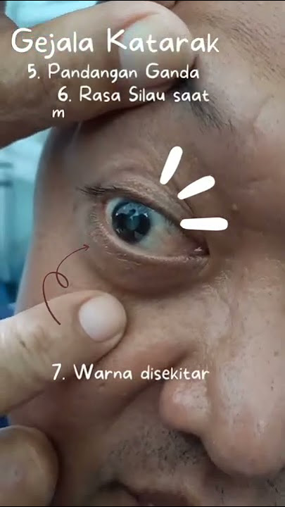 Penjelasan tentang Mata Katarak