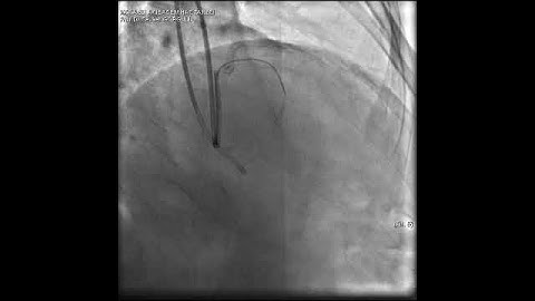 Aortic dissection and radial rupture during retrograde CTO PCI: Management of complications VİDEO 2