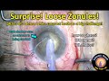 Surprise! Loose zonular support during cataract surgery