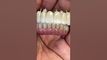 No Pink vs. Pink Esthetic for Full Mouth Zirconia Implants
