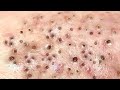 Loan nguyen acne treatment 14933