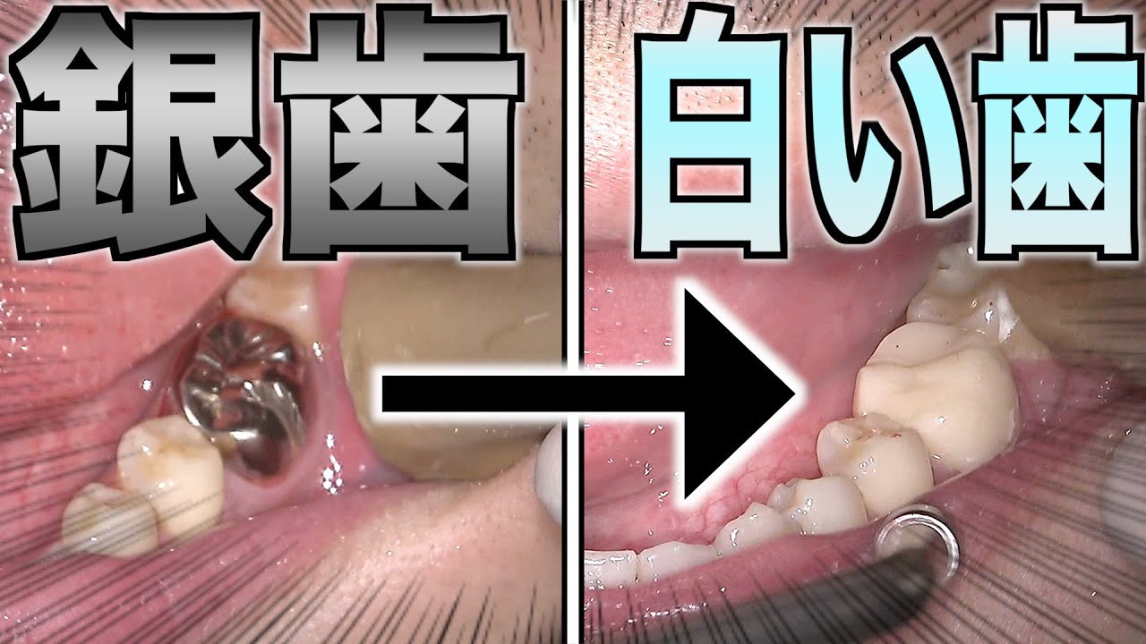 銀 歯 外す