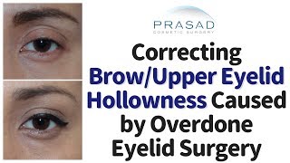 How to Correct Upper Eyelid/ Brow Hollowing and Asymmetry from Previous Upper Eyelid Surgery