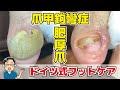 肥厚爪（爪甲鉤彎症）の爪切り【分厚くなった爪のケア】（Thickened nails・THICK TOENAIL・두꺼워 손톱）