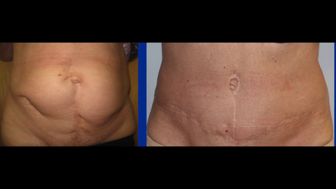 Where Is A Fleur De Lis Tummy Tuck Scar Placed in Surgery?