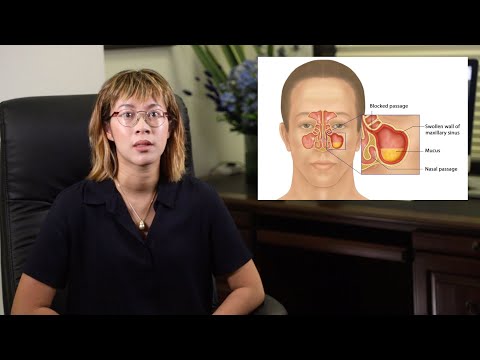 Video: Gnojni Sinusitis, Akutni In Kronični: Zdravljenje, Simptomi, Zapleti