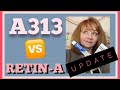A313 Pommade| Retin-A| 4 Month Update & Final Thoughts