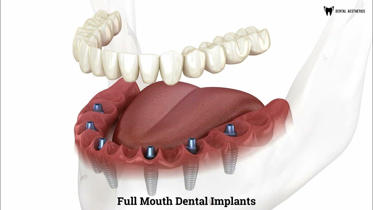 3D Dental Animation of Full Mouth Dental Implants Procedure YouTube