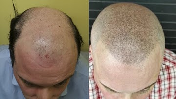 Healed vs. Fresh Scalp Micropigmentation (Comparison Video)