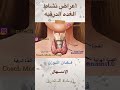 اعراض نشاط الغدة الدرقية