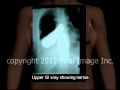 Paraesophageal Hernia video - Animation by Cal Shipley, M.D. Trial Image Inc.