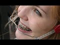 Laura Orthodontic Braces with High Pull Headgear and Milwaukee Brace!