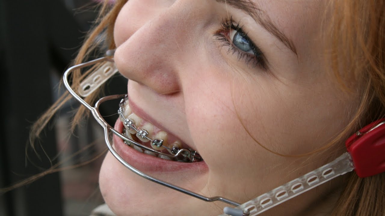 Laura Orthodontic Braces With High Pull Headgear And Milwaukee Brace 