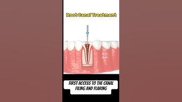 Root Canal Obturation