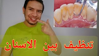 الحل النهائي لتراكم الجير و الطعام بين الاسنان | احسن طريقه لتنظيف بين الاسنان