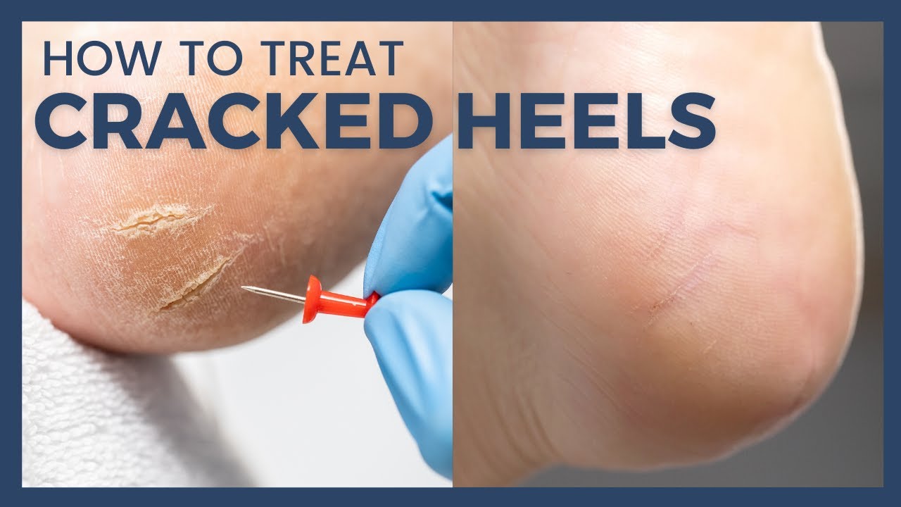 The Downside of Wearing Thongs and Sandals in Summer – Cracked Heels -  Sutherland Podiatry