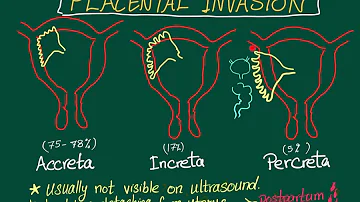 Como diagnosticar placenta Percreta?