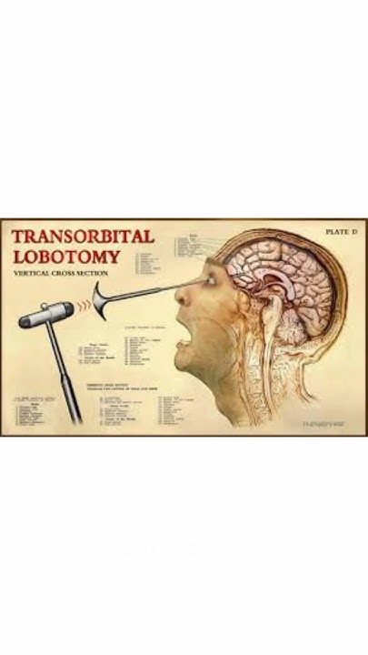 WHO INVENTED THE LOBOTOMY? PART 3/4 #history #science #lobotomy #autism