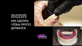 ПОЛНЫЙ СЪЕМНЫЙ ПРОТЕЗ (ТОП ФИШКИ: ЦС, КЛАПАННАЯ ЗОНА) нижняя челюсть