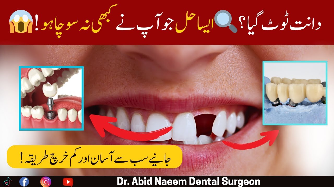 How to Replace a Missing Tooth? Best Affordable Methods |Dr. Abid Naeem