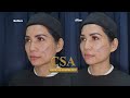 Nonsurgical full face rejuvenation using fillers and Botox on a 48 year old