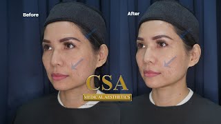 Nonsurgical full face rejuvenation using fillers and Botox on a 48 year old