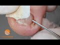 Little spicule = Challenging job! | Consequences of an incorrect cut of the toenail [Podology]