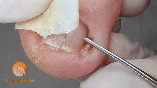 Little spicule = Challenging job! | Consequences of an incorrect cut of the toenail [Podology]